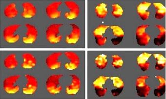 Kỹ thuật mới hỗ trợ điều trị bệnh hô hấp
