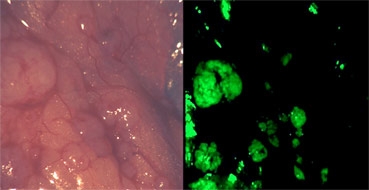 Làm khối u phát sáng có thể giúp bác sĩ loại bỏ ung thư dễ dàng