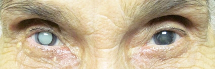 Những điều cần biết về bệnh đục thủy tinh thể