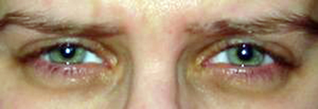 Những giải pháp phòng trị “hội chứng thị lực máy tính”