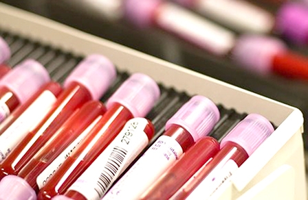 Xét nghiệm máu giúp phát hiện và điều trị sớm bệnh Parkinson