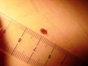 Nhận diện nốt ruồi và mụn thịt lành tính