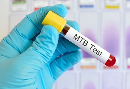 Phương pháp mới chẩn đoán bệnh lao chỉ trong 1 giờ