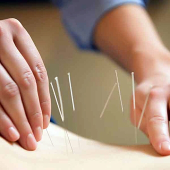 Châm cứu và tập pilates giúp giảm triệu chứng mãn kinh