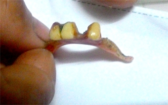 Nuốt răng giả, bệnh nhân bị thủng ruột