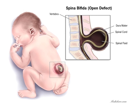 Miếng vá sinh học từ dây rốn có thể chữa tật
 nứt đốt sống ở thai nhi