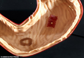 Robot xếp hình giúp khắc phục các vấn đề trong dạ dày