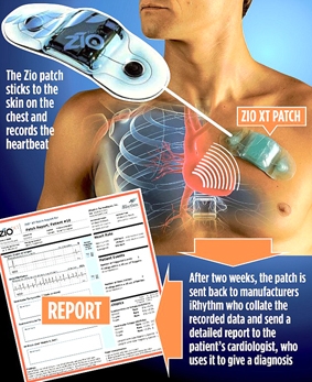 Thiết bị phòng ngừa đột tử cho người rối loạn nhịp tim
