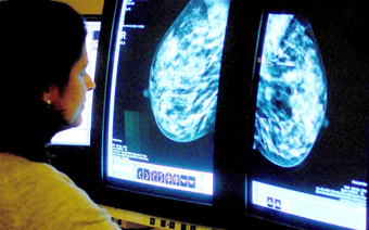 Trí tuệ nhân tạo cải thiện chẩn đoán nguy cơ ung thư vú