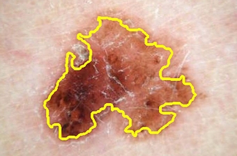 IBM phát triển công nghệ chẩn đoán ung thư da qua điện thoại