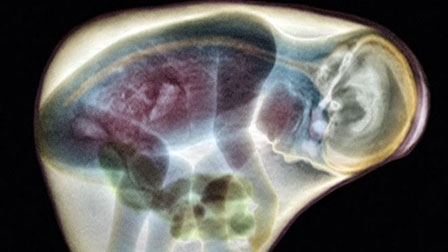 Chụp MRI giúp tầm soát kịp thời sức khỏe não bộ của thai nhi