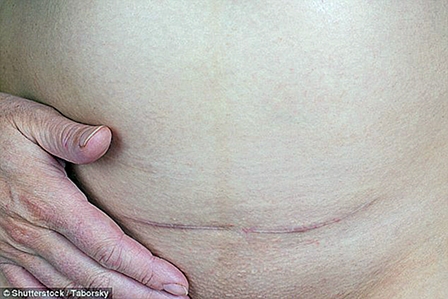 Tái tạo thành công 
tế bào mỡ giúp trẻ hóa da 
và ngăn ngừa sẹo