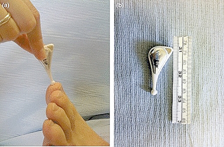 Chẩn đoán sớm tổn thương thần kinh ở bệnh nhân tiểu đường