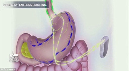 Thiết bị cấy ghép vào dạ dày hỗ trợ giảm cân v-Bloc