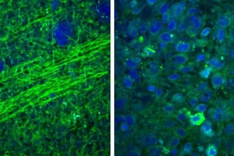 Ảnh laser giúp phẫu thuật chính xác khối u não