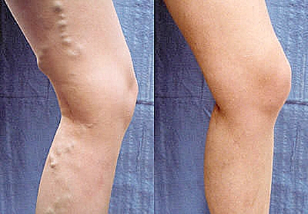 Những liệu pháp tự nhiên chữa suy giãn tĩnh mạch