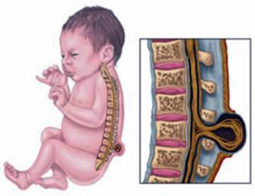 Phẫu thuật trong bào thai - hy vọng cho các bé bị tật nứt đốt sống