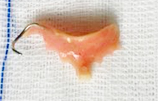 Nhập viện vì nuốt răng giả