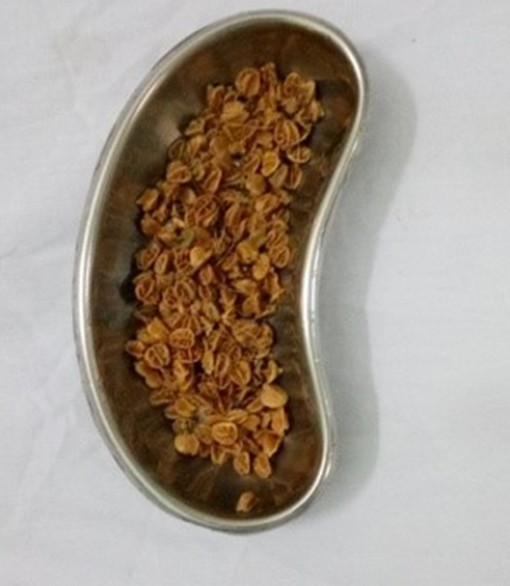 Bé trai bị tắc hậu môn vì nuốt hạt sơ ri