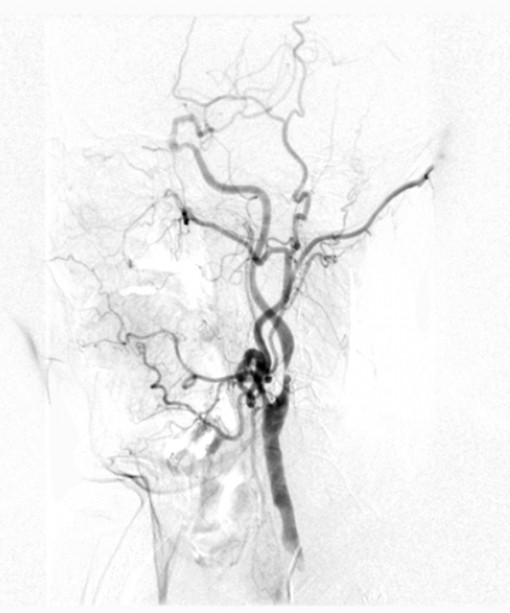 Hẹp động mạch cảnh – “sát thủ” thầm lặng gây tai biến mạch máu não