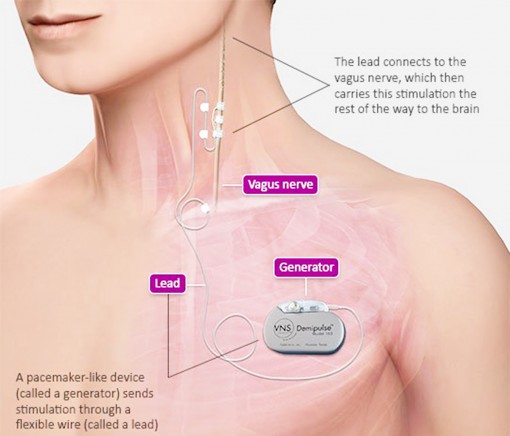 Kỹ thuật mới giúp điều trị  trầm cảm kháng trị