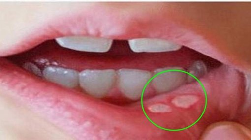 Những dấu hiệu đặc trưng cảnh báo cơ thể thiếu kẽm