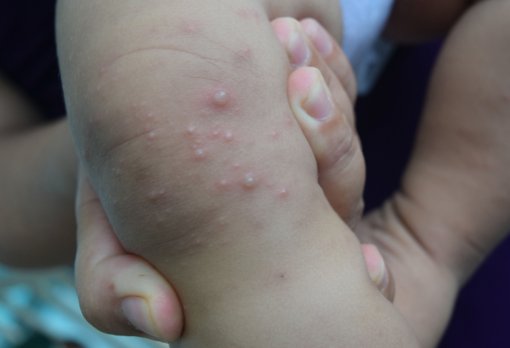 Cần Thơ: Một trẻ tử vong vì tay chân miệng