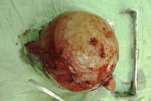 Bệnh viện Phụ sản Cần Thơ​ phẫu thuật thành công u xơ tử cung nặng gần 6kg