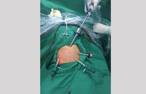 Bệnh viện Nhi đồng TP Cần Thơ phẫu thuật nội soi khâu thủng

dạ dày tá tràng cho bé 6 tuổi