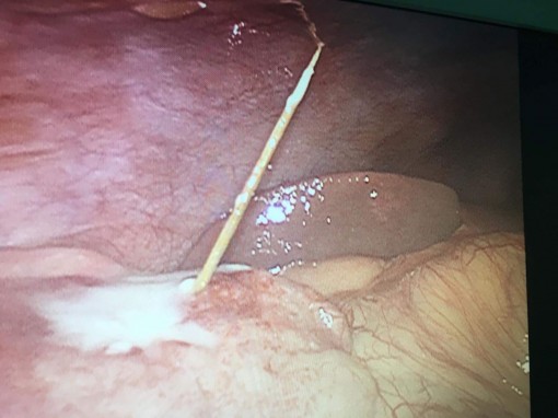 Thủng ruột do tăm xỉa răng