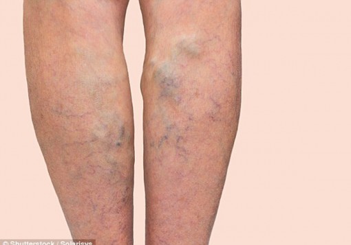 Giãn tĩnh mạch – dấu hiệu cảnh báo hình thành cục máu đông?