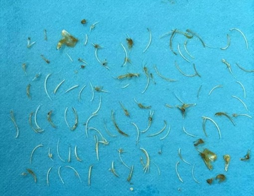 Người đàn ông bị tới 100 mảnh xương cá mắc kẹt trong ruột