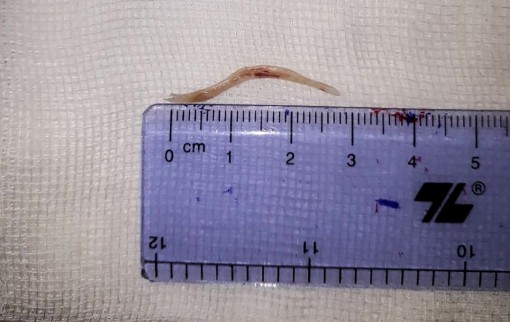 Bị xương cá tra đâm thủng dạ dày