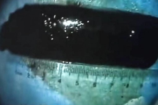 Bật lửa nằm trong dạ dày 20 năm