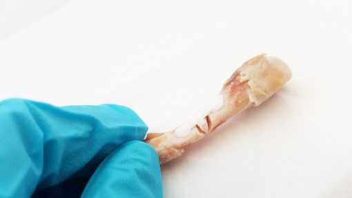 Miếng dán sinh học chữa gãy xương không cần nẹp và ốc vít