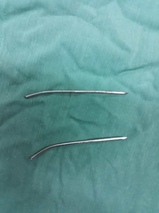 Hy hữu đinh cố định xương đâm xuyên thực quản, khí quản