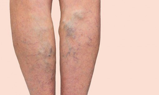 Người càng cao lớn, càng dễ bị giãn tĩnh mạch