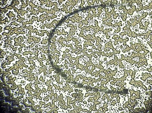 Phát hiện và điều trị sớm bệnh giun chỉ