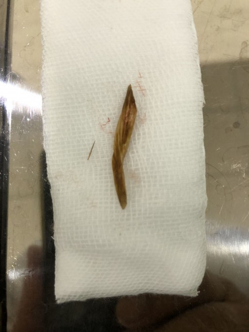 Tưởng mắc bệnh trĩ nào ngờ thủ phạm là xương cá