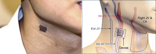 Thiết bị đeo phòng ngừa

đau tim và đột quỵ 24/24