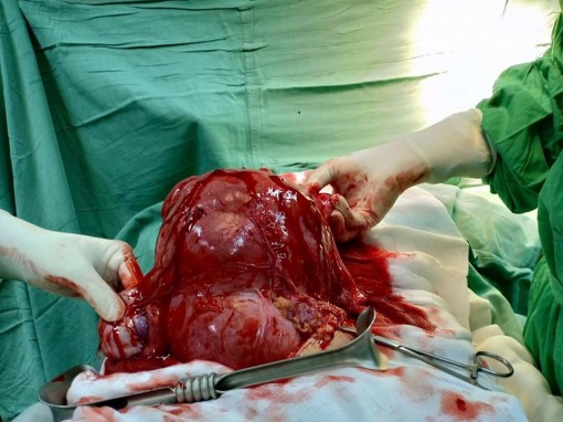 Bóc tách khối u 4kg cho nữ bệnh nhân 37 tuổi