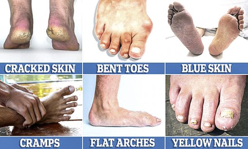 Chẩn bệnh từ biểu hiện bàn chân