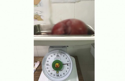 Bóc tách thành công khối u xơ tử cung nặng gần 5 kg