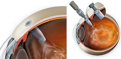 Thiết bị ngăn ngừa mù lòa vì AMD dạng “ướt”