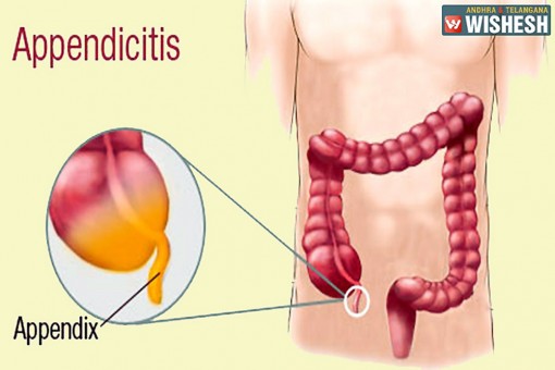 Bệnh Parkinson có thể bắt nguồn từ ruột thừa