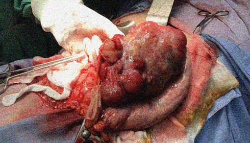 Cắt khối u nặng hơn 2kg chiếm toàn bộ dạ dày