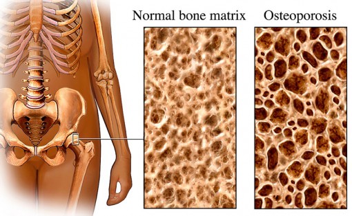 Xác định gien liên quan đến loãng xương