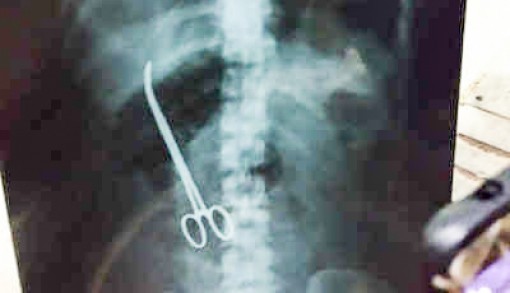 Bỏ quên chiếc kẹp

trong bụng bệnh nhân