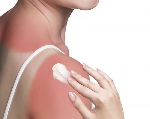 Vì sao dùng kem chống nắng vẫn bị “ăn nắng”?
