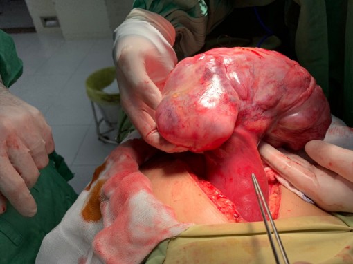 Gan có khối u nặng 1,3kg mà người bệnh không hay biết